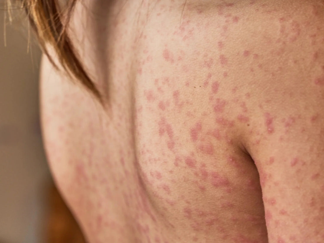 WHY ORGANIC CBD OIL IS THE BEST CHOICE FOR SENSITIVE AND PSORIASIS SKIN